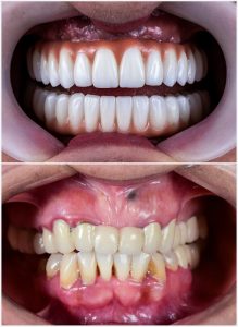 Full,Mouth,Rehabilitation,By,Crowns,Veneers,And,Implants