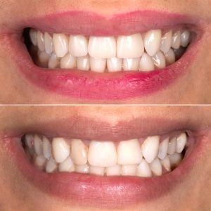 Perfect,Smile,Before,And,After,Bleaching,Procedure,Whitening,Of,Zircon