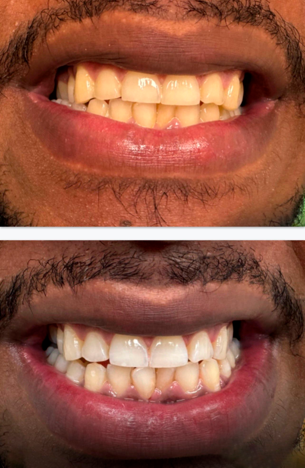 ANTES-DESPUES-BLANQUEAMIENTO